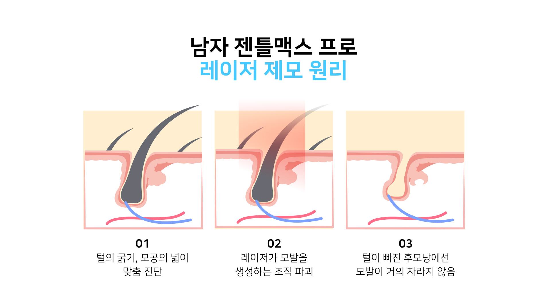 남자 젠틀맥스 프로 레이저 제모 원리 