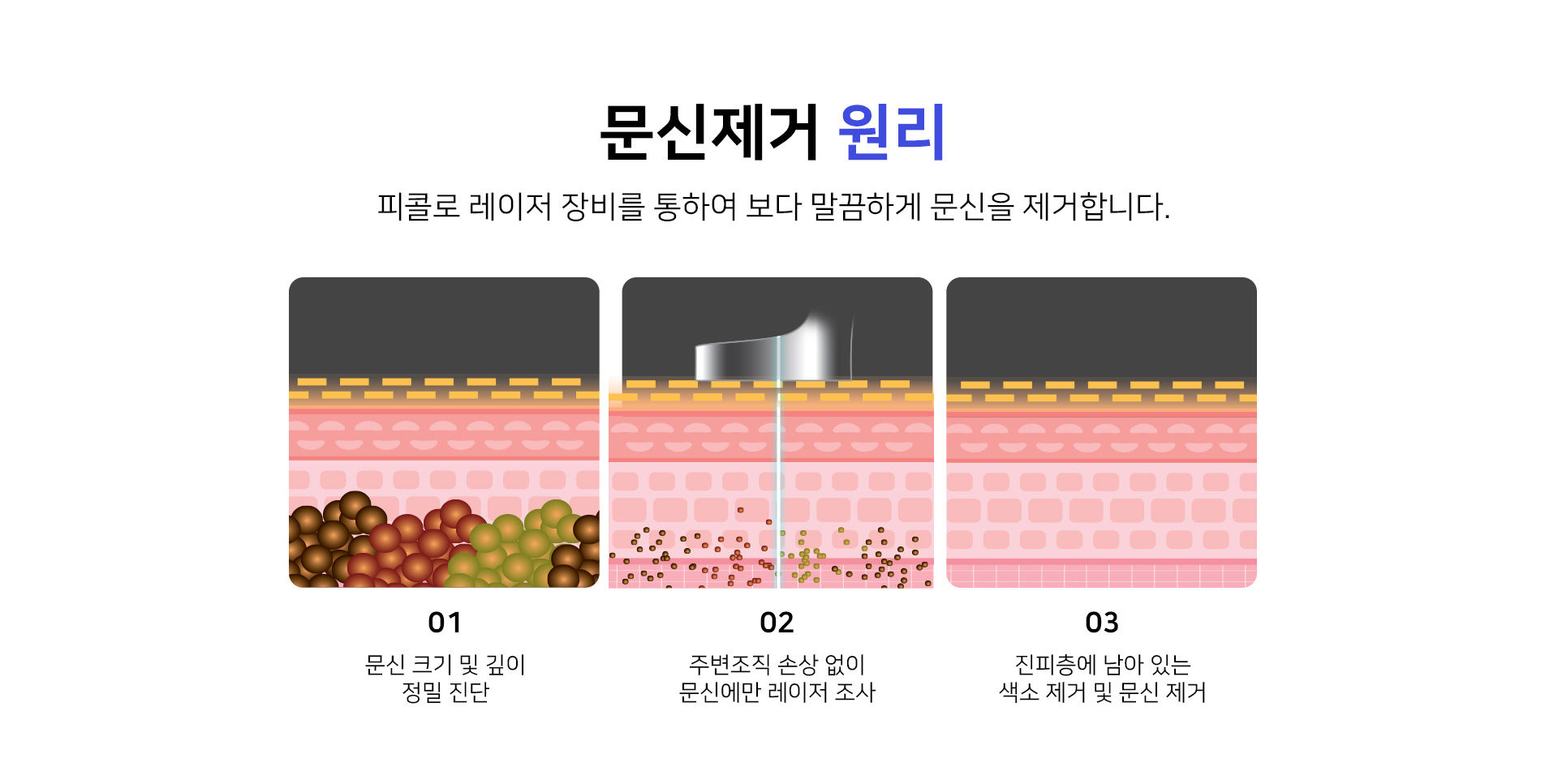 문신제거 원리 