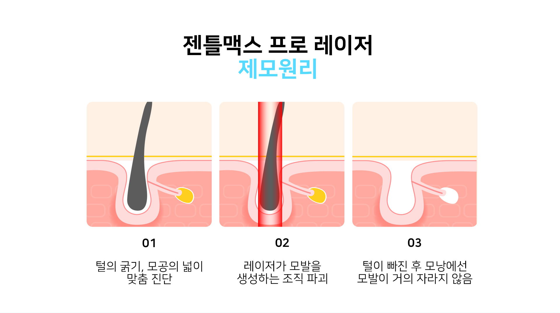 젠틀맥스프로 레이저 제모원리 